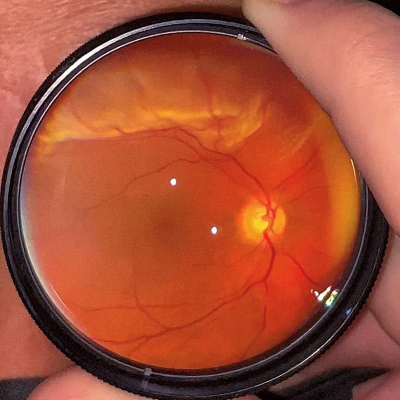 descolamento-de-retina descolamento-de-retina